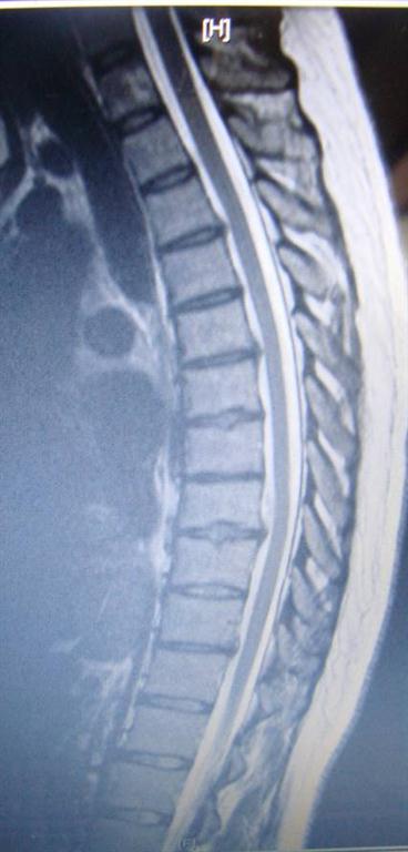 thoracic disc herniation treated by Millville chiropractor